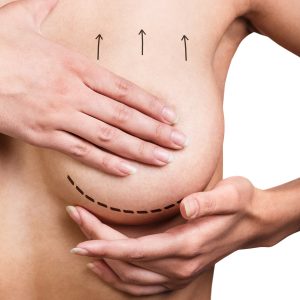 Пластическая хирургия | Лифтинг груди