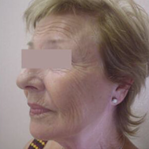 Before-Подтяжка лица и шеи, круговая блефаропластика