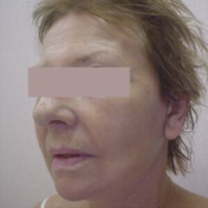 After-Подтяжка лица и шеи, круговая блефаропластика