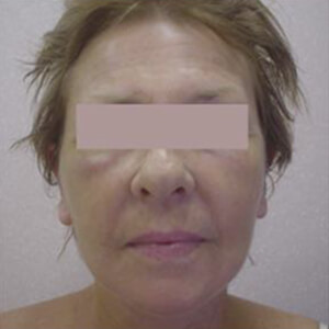 After-Подтяжка лица и шеи, круговая блефаропластика